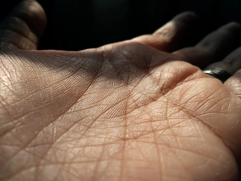 Значение зуда, патогенетические механизмы его формирования и оценка клинических проявлений при атопическом дерматите